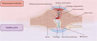 The promise of Synovial Joint-on-a-Chip in rheumatoid arthritis